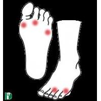 リウマチの症状、原因、靴と中敷きによる対策