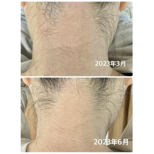 皮膚科に行ってもよくならない皮膚炎の手あて