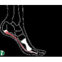 ハイアーチの症状、原因、靴と中敷きによる対策