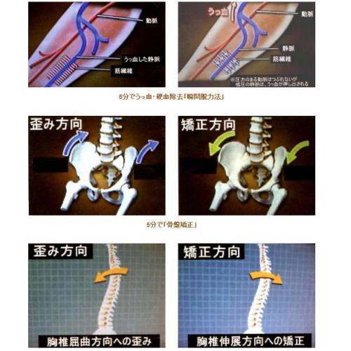 骨盤矯正